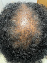 Load image into Gallery viewer, Before using scalp restore oil, client has tight, clogged , inflamed follicles caused by CCCA. 

